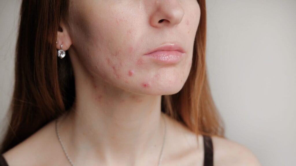 Links Between Diet and Acne